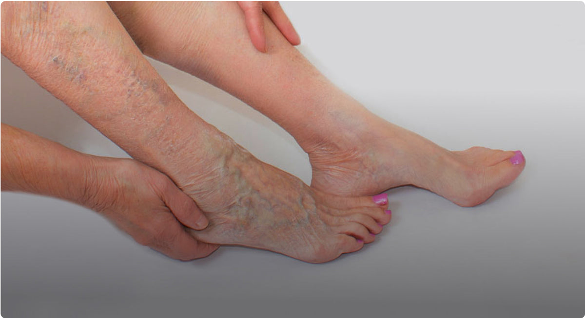 Varicose, Spider Veins & Tired Legs