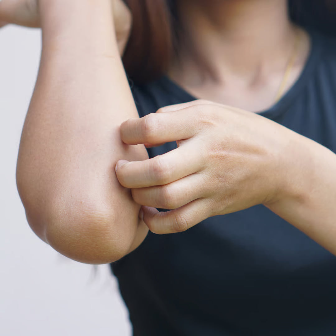 Eczema, Psoriasis, Dermatitis